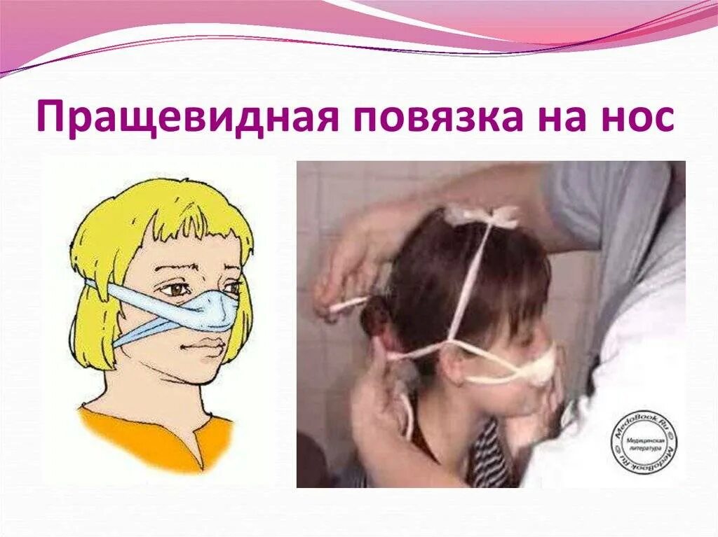 Техника наложения пращевидной повязки. Наложение пращевидной повязки на нос. Пращевидная повязка техника. Пращевидную повязку на нос при кровотечении. Алгоритм наложения повязки на нос.
