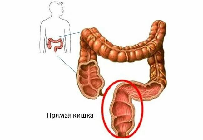 Язвенный колит проктосигмоидит. Эрозивный проктит симптомы. Проктит прямой кишки симптомы.