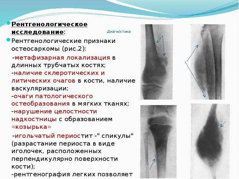 Очаг литической деструкции костной ткани. Литическая деструкция что это. Рентгенологические признаки саркомы. Литическая деструкция что это. Литическая деструкция что это.