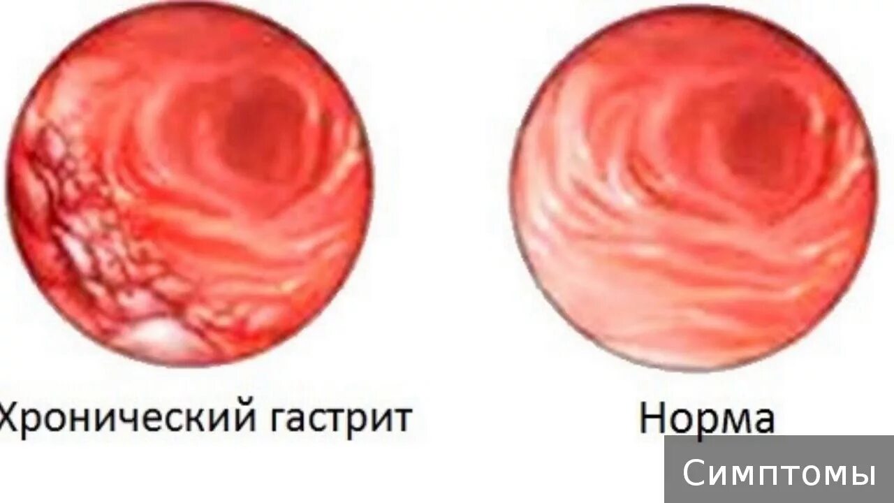 Хронический панкреатин. Хроническ е заболевания. Хронический что это. Хронический эндометрит симптомы. Хронический холецистит.