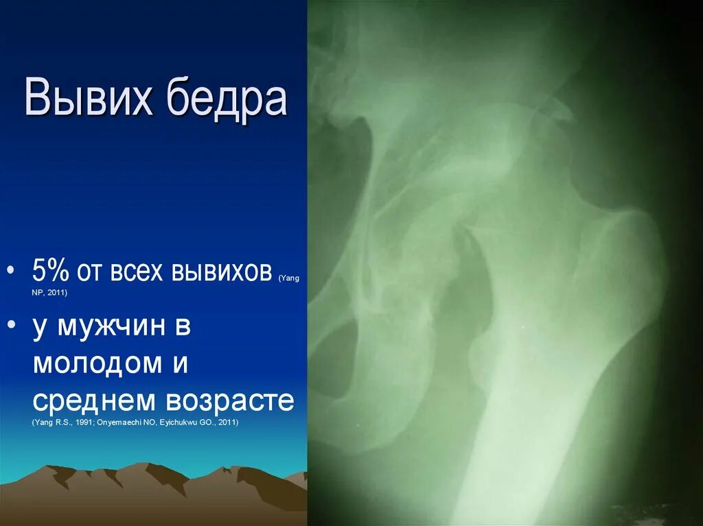 Задневерхний вывих бедра. Вывих бедренного. Травматические вывихи бедра: классификация. Врожденный вывих тазобедренного сустава. Вывихи тазобедренного сустава классификация.