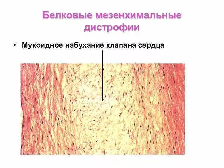 Мезенхимальные дистрофии мукоидное набухание. Белковые мезенхимальные дистрофии мукоидное набухание. Мукоидное набухание патогенез. Мезенхимальные углеводные дистрофии.