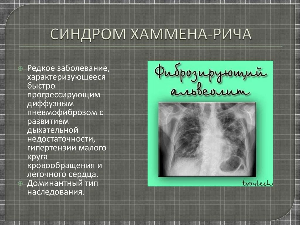 Диффузионная дыхательная недостаточность. Фиброзирующий альвеолит (синдром хаммена-рича). Генетический синдром вильямса. Идиопатический фиброзирующий альвеолит синдромы. Синдром ричи.