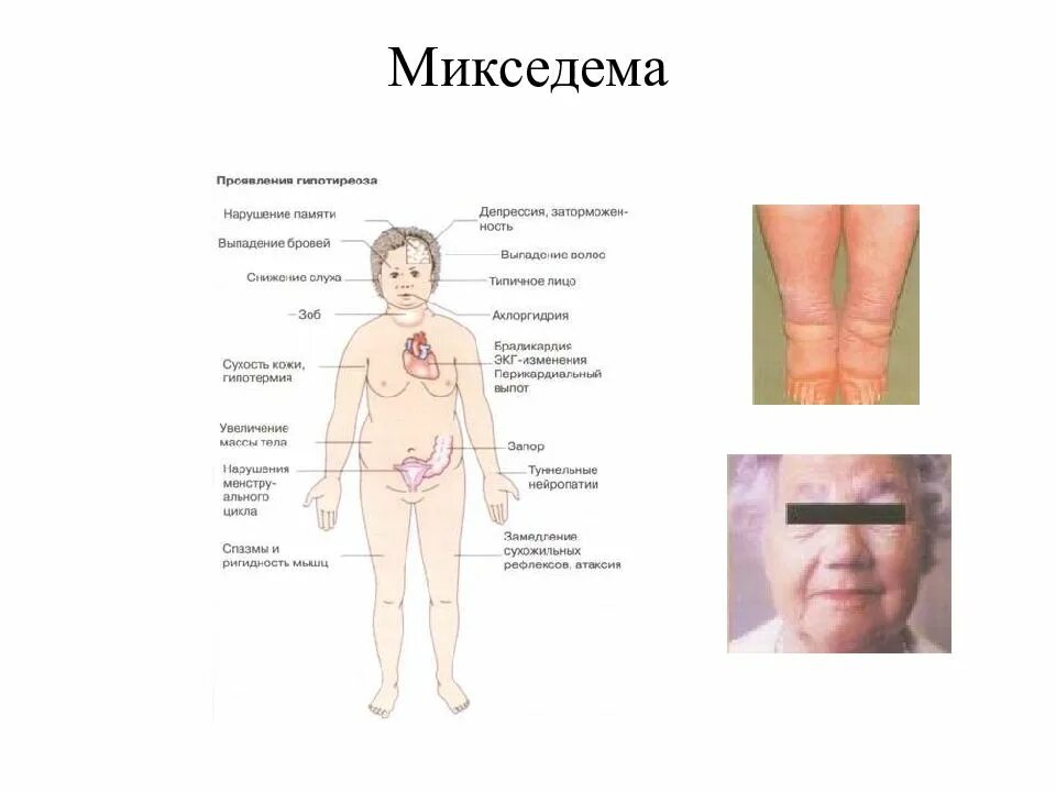 Микседема что за болезнь. Причины возникновения микседемы. Клинические проявления микседемы. Гипотиреозе отеки (микседема).