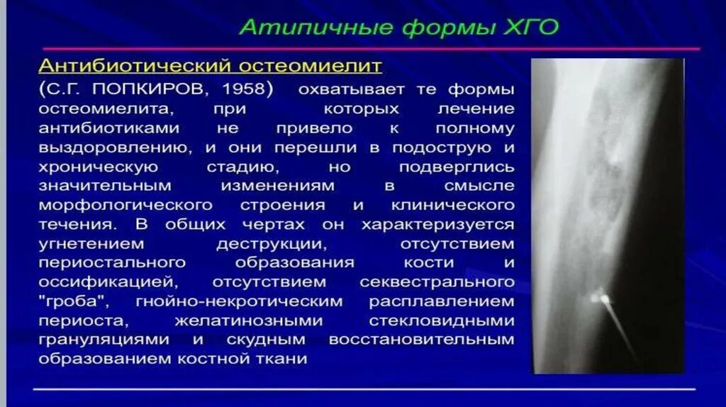 Атипичные формы хронического остеомиелита. Хронический остеомиелит свищевая форма. Атипичный остеомиелит. Хронический склерозирующий остеомиелит. Атипичный остеомиелит.