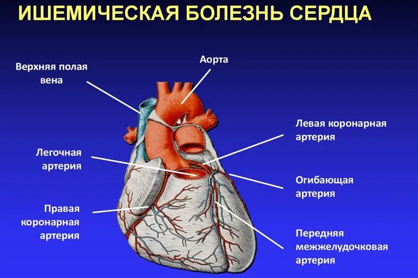 Ишемическая болезнь сосудов. Коронарная болезнь сердца. Коронарные артерии сердца. ИБС атеросклероз коронарных артерий.