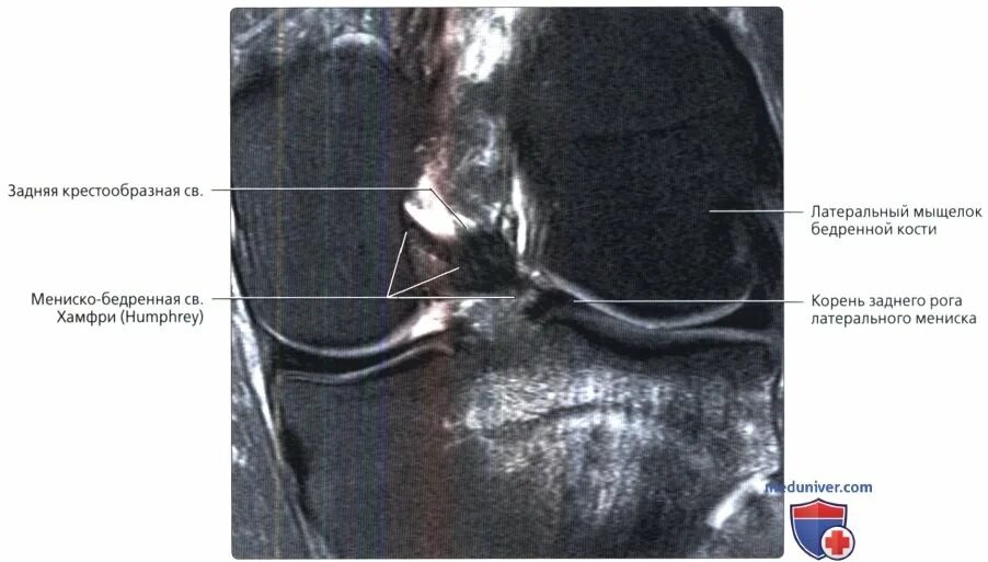 Мыщелки отек латерального мыщелка. Мениско бедренная связка мрт. Некроз мыщелка бедренной кости мрт. Гипоплазия мыщелков бедренной кости мрт. Задняя мениско бедренная связка мрт.