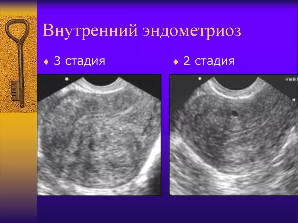 Признаки внутреннего эндометриоза на узи