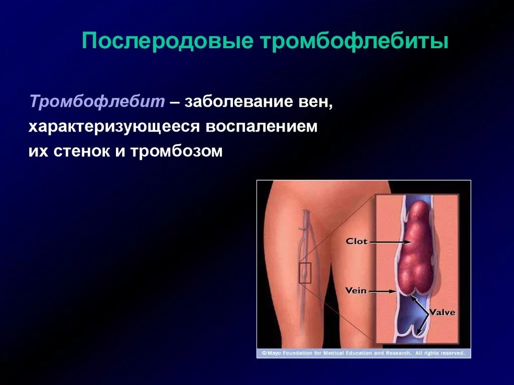 Послеродовые воспалительные заболевания. Послеродовый тромбофлебит. Послеродовый тромбофлебит вен.