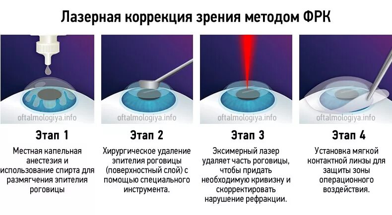 Лазерная коррекция зрения методом ФРК. Фемто ласик лазерная коррекция. Лазерная коррекция зрения метод Фемто ласик. Фоторефрактивная кератэктомия. Зрение 2 операция