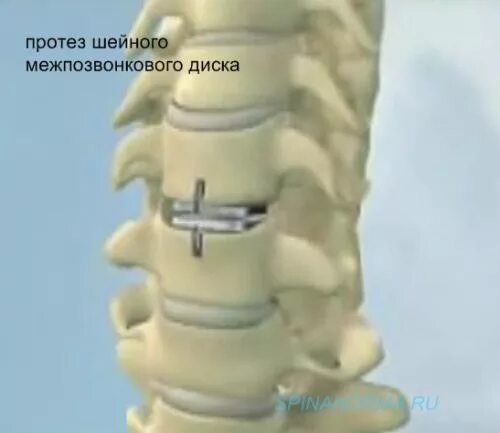 Кейдж имплант шейного отдела. Имплант межпозвонкового диска l5-s1. Имплант межпозвонкового диска l5-s1 реабилитации.