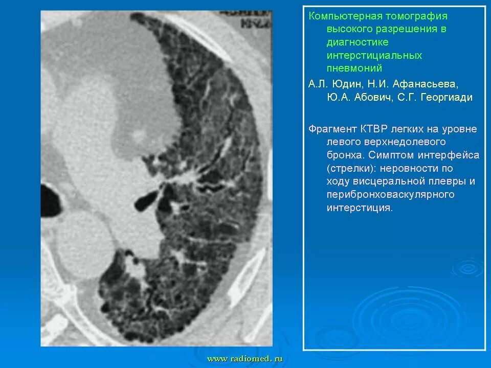 Легочный компонент. Интерстициальные болезни легких (ибл. Интерстициальные поражения легких классификация. Легочный компонент. Отек легких диагностические критерии.