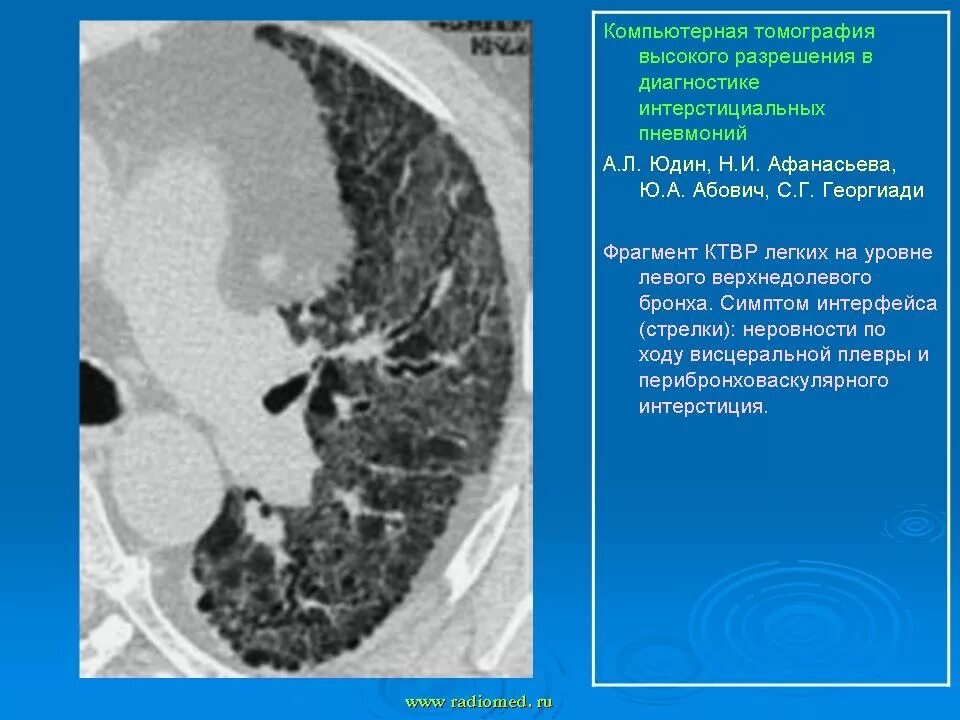 Интерстициальная пневмония на кт. Лимфоцитарная интерстициальная пневмония кт. Перибронховаскулярной инфильтрации. Интерстициальные болезни легких кт. Интерстициальные изменения в легких что это