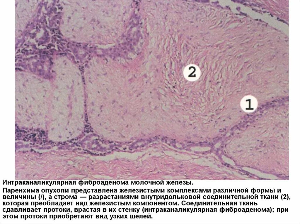 Овсяно клеточная карцинома. Филлоидная фиброаденома молочной железы гистология. Интраканаликулярная фиброаденома гистология. Филлоидная фиброаденома молочной железы узи. Микроскопическое строение опухоли.