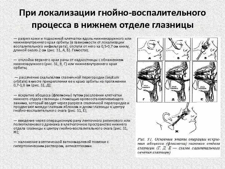 Пути распространения гноя при флегмонах стопы. Флегмоны бедра пути распространения. Разрезы при флегмонах нижней конечности. Флегмона голени клиника. Флегмоны бедра пути распространения.