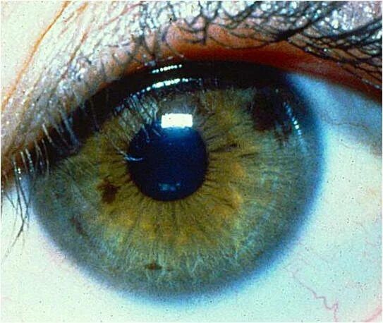 Почему мешает в глазах. Брушфильда пятна брушфильда. Пигментный невус Радужки. Меланома радужной оболочки глаза.