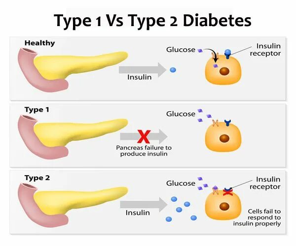 Type 1 Diabetes. Diabetes Types. Type 2 Diabetes. Diabetes Type 1 and 2. Sites type 1