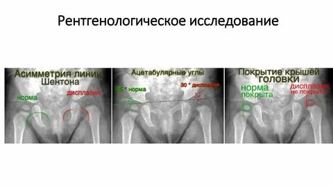 Нормы ацетабулярного угла у детей