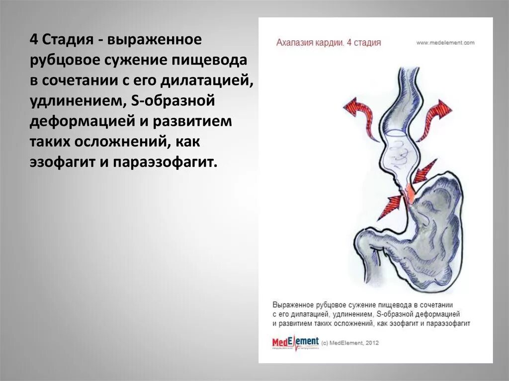 Недостаточность пищевода. Ахалазия кардии пищевода степени. Ахалазия пищевода 4 стадии. Недостаточность кардии пищевода стадии. Ахалазия пищевода 3 степени.