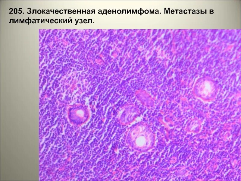 Метастазы в лимфоузлах при раке молочной. Аденолимфома гистология. метастаз аденокарциномы в лимфатический узел микропрепарат. метастазы в лимфоузлах микропрепарат. метастазы в лимфатическом узле микропрепарат.