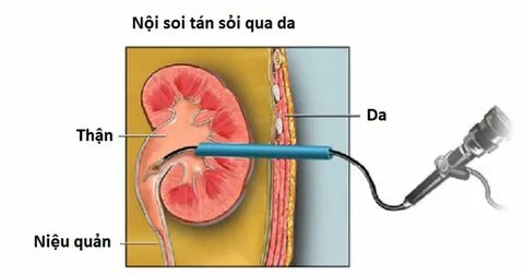 Операция на камнях мочеточника