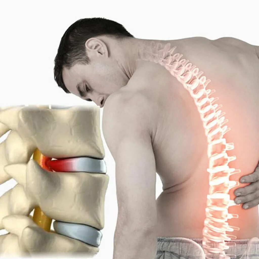 Позвоночник человека лечение. Межпозвоночная грыжа. Грыжи межпозвоночная грыжа. Межпозвоночная грыжа поясничного.