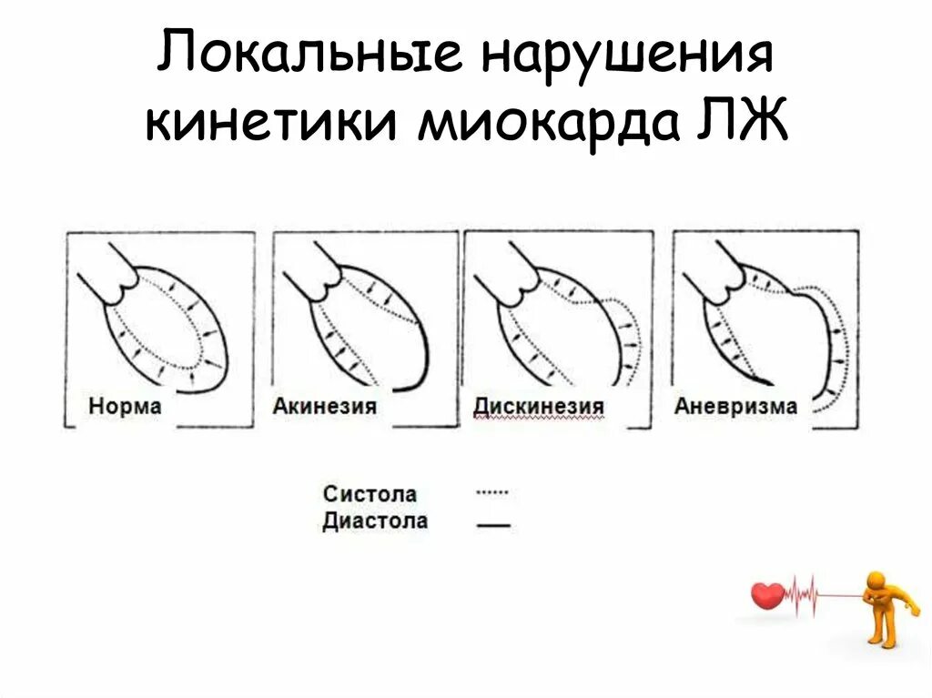 Нарушение функции миокарда лж. Локальные нарушения это. акинез гипокинез дискинезия. акинез миокарда. акинез сердца.
