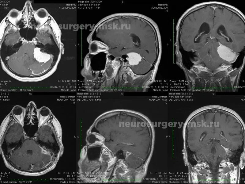 Менингиома лобной кости кт. Менингиома лобной доли кт. Менингиома головного мозга кт. После операции менингиомы головного мозга