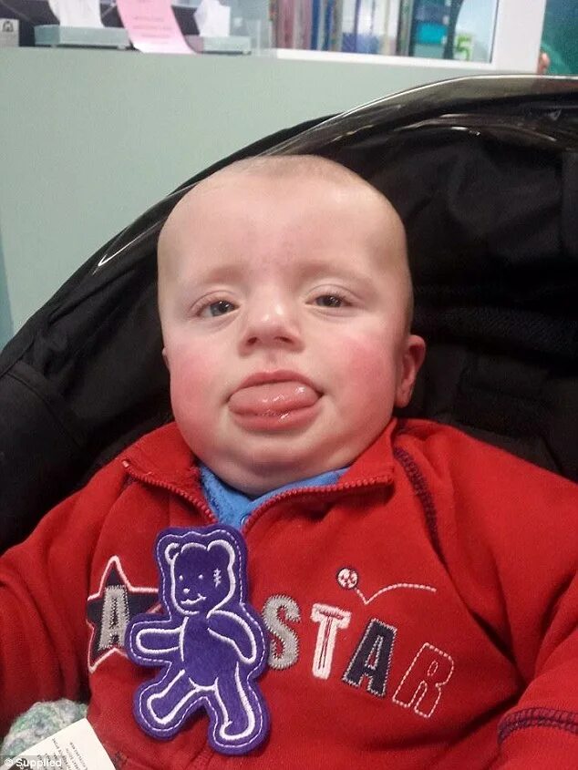 зубы у детей с синдромом дауна. грудничок высовывает язык. язык ребенка дауна. язык ребенка дауна. язык ребенка дауна.