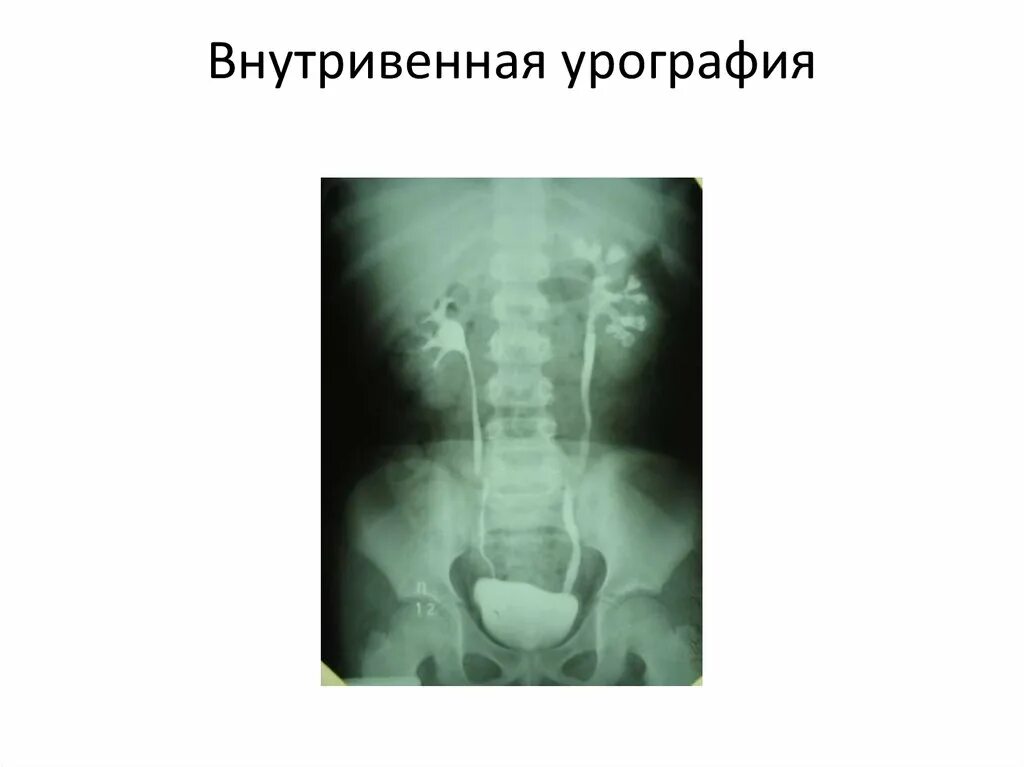 Как делается урография. Внутривенная и экскреторная урография почек. экскреторная пиелография. внутривенная экскреторная урография подготовка. внутривенная урография почек алгоритм.