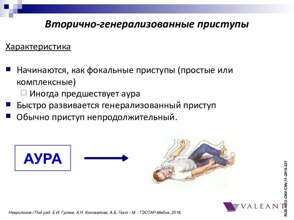 Простые припадки. Генерализованный приступ. Генерализованные припадки. Генерализованный судорожный приступ. Фокальные приступы.