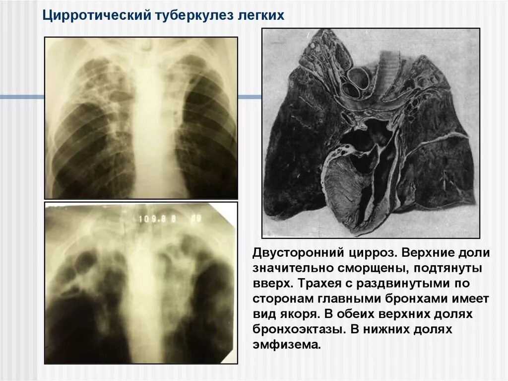 Цирроз легкого туберкулез рентген. Цирротический туберкулез легких снимок. Цирротический туберкулёз лёгких кт. Фиброзно Цирротический туберкулез.