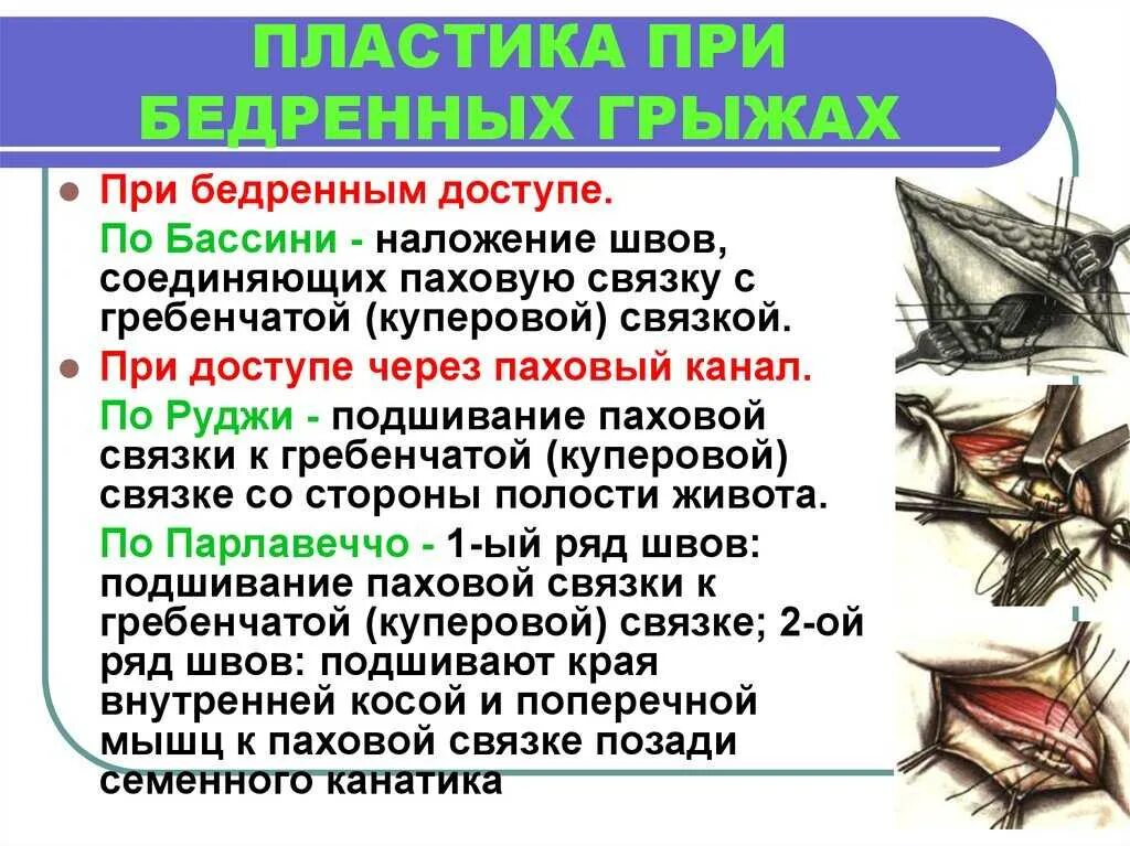 Лечение бедренной грыжи. Бедренная грыжа Оперативная хирургия. Ущемленная бедренная грыжа.