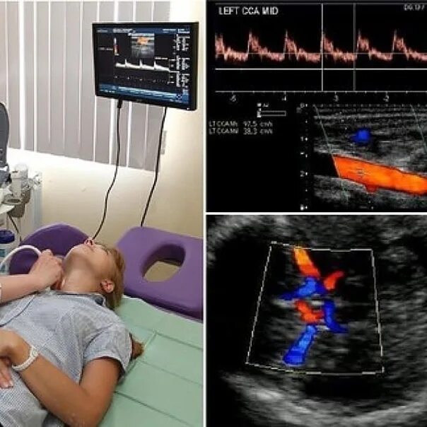 Допплерография ребенку. Допплеровское сканирование сосудов головы и шеи. УЗИ сосудов шеи доплер. Ультразвуковая допплерография головного мозга. Ультразвуковая допплерография магистральных сосудов.