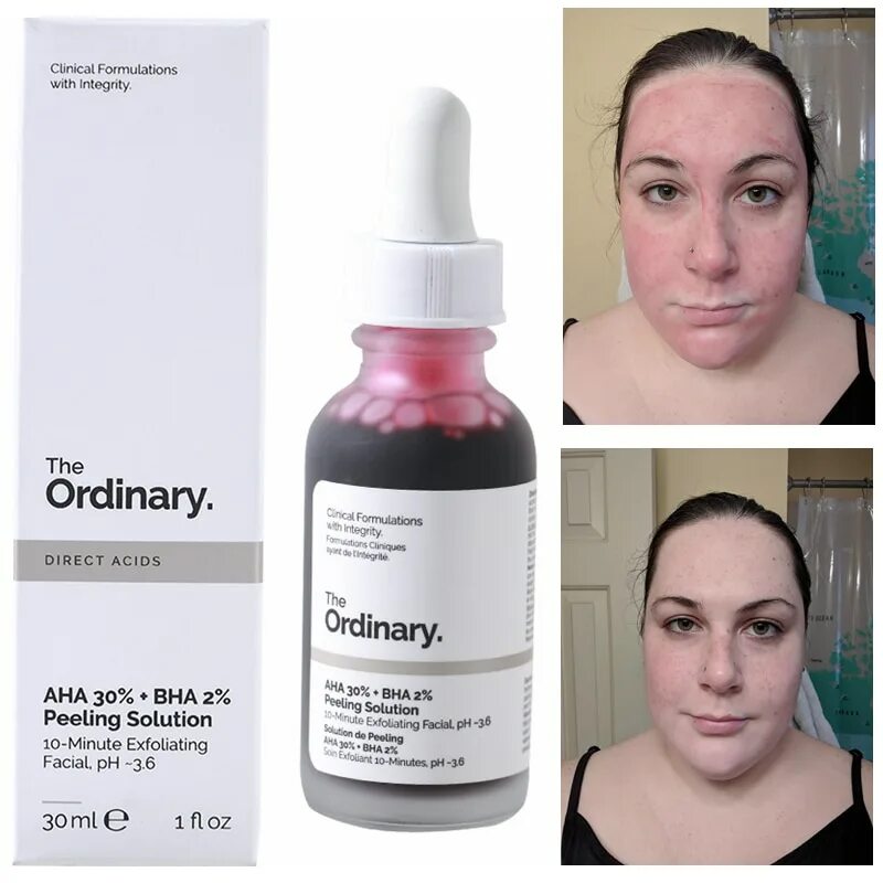 Кислотный пилинг для лица как пользоваться. Сыворотка the ordinary aha 30% *bha 2%. ординари aha 30% + bha 2% peeling solution.. пилинг the ordinary aha 30 bha 2. пилинг сыворотка ординари.