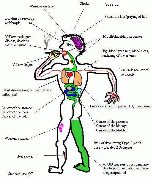 Health risks. Healthy risks of smoking. Ծխելու հետեվանքները Effects of smoking.