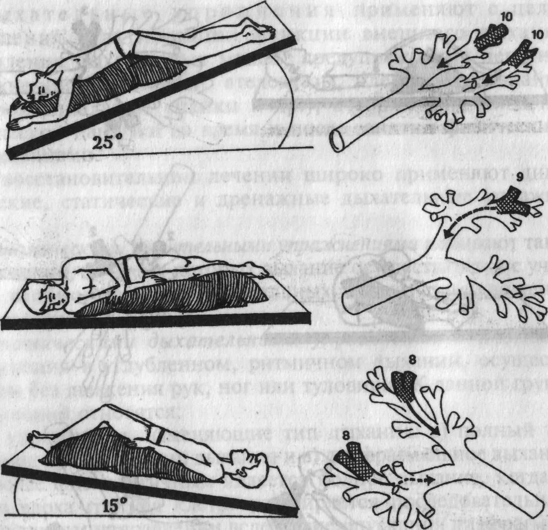 Дренажные положения для отхождения мокроты. Дренажная гимнастика для отхождения мокроты. Постуральный дренаж для отхождения мокроты. Дренажная гимнастика для отхождения мокроты для детей.