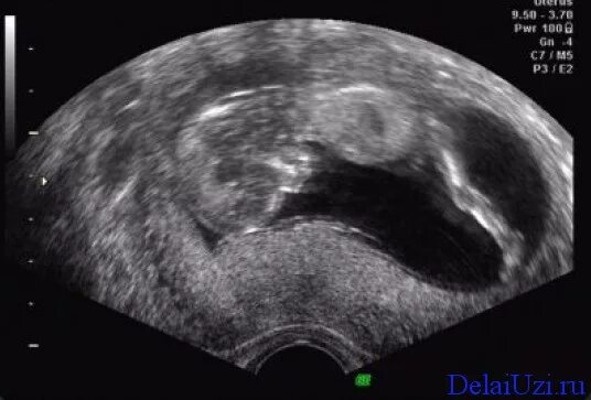 ребёнок в утробе матери по неделям. ребенок в утробе по месяцам. 170 недель. животик на 24 неделе беременности. норма сердцебиения плода по неделям беременности 1 триместр.