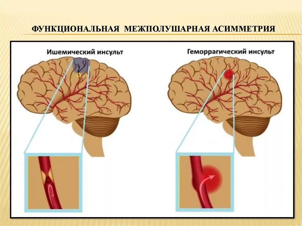 Ишемический и геморрагический инсульт. Ишемический инсульт мозга. Ишемический и геморрагический инсульт головного мозга. Типы геморрагического инсульта.