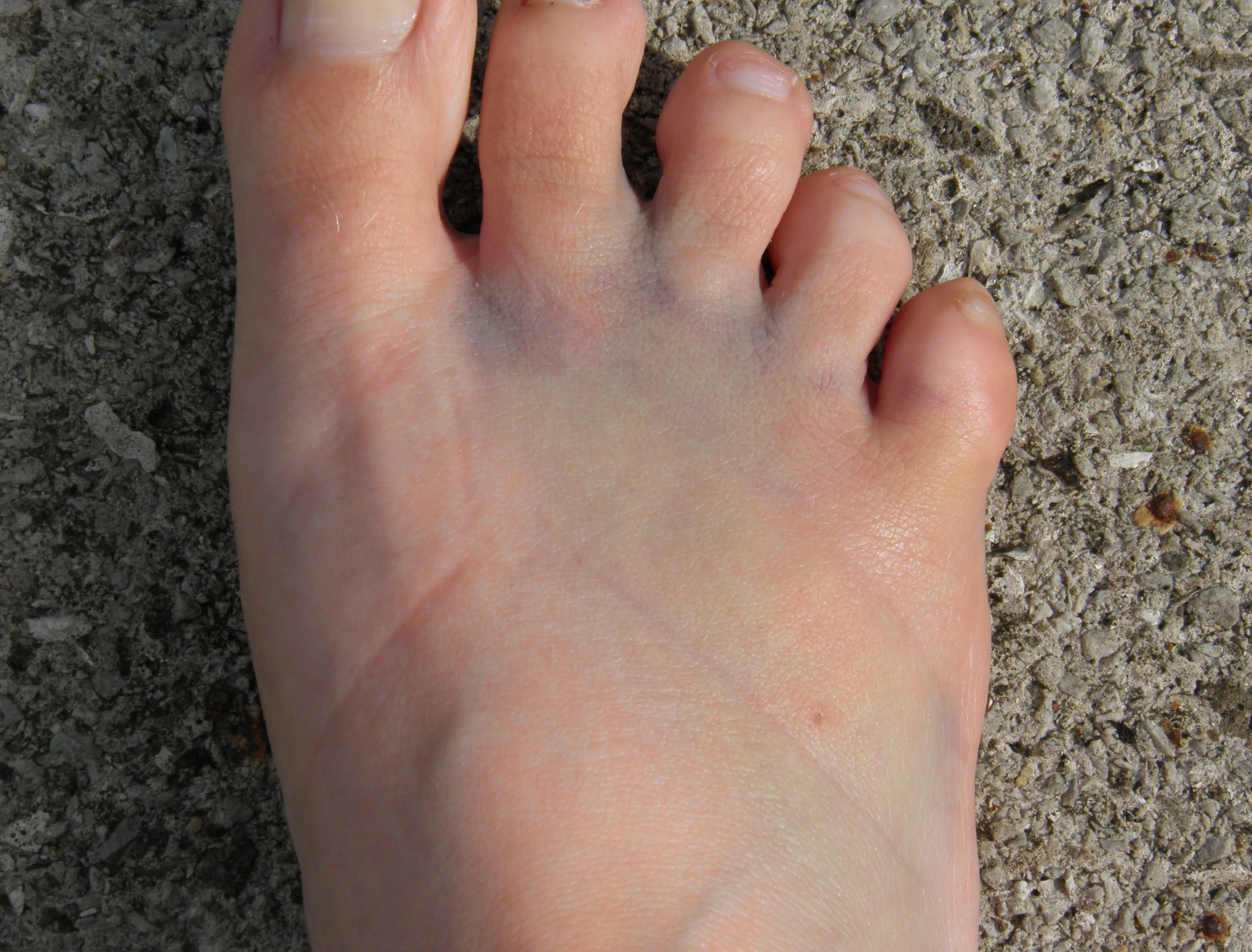 Корткикпальцы на ногах. Перелом ппальцана ноге. Красивый мизинец на ноге. Пернлнм пальца на ноге. Мозолин для ног.
