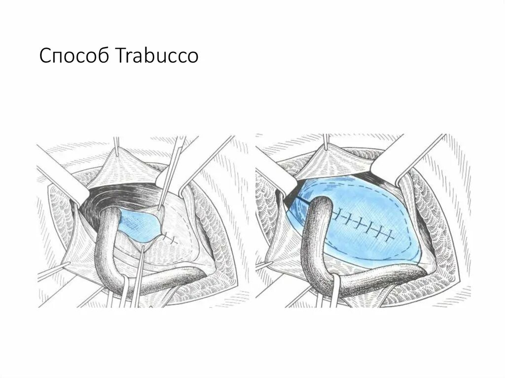 Грыжесечение по трабукко. Грыжесечение по Лихтенштейну пупочной грыжи. Герниопластика по трабукко. Лихтенштейн операция грыжа