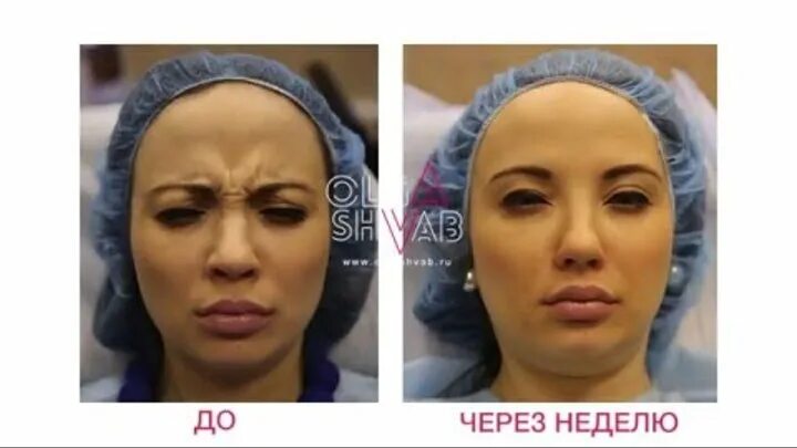 Ботоксное лицо как выглядит Woman Mirror Yoga per il viso, Rughe, Botox