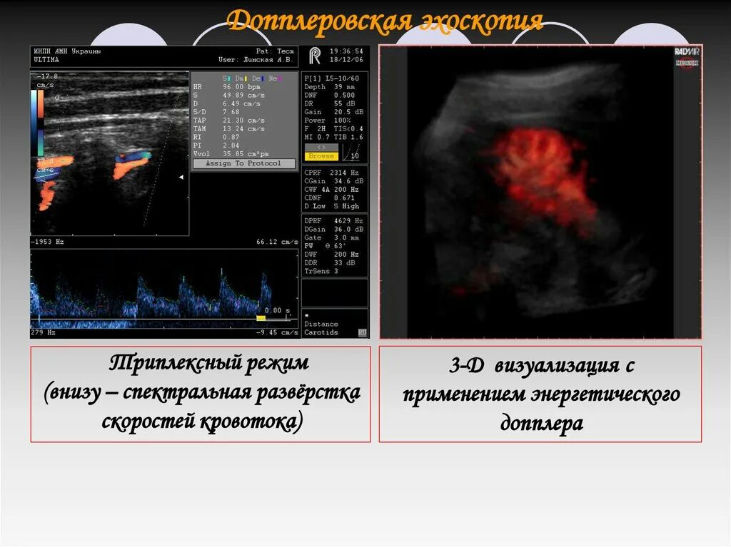 Доплер кровотоки. УЗИ допплерография. УЗИ импульсный допплеровский режим. Импульсно-волновой допплер в УЗИ. Допплеровских режимах ультразвукового исследования.