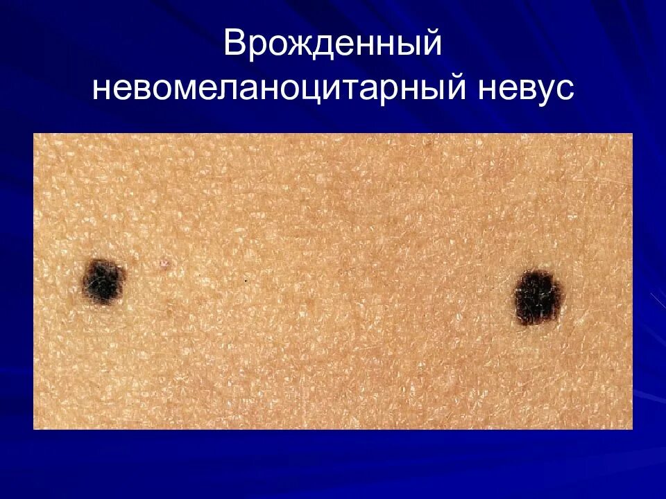 Плотный обнаружить