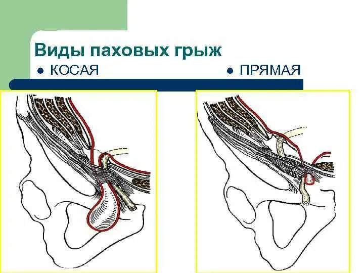 Прямая паховая грыжа схема. Косая паховая грыжа анатомия. Косая.паховая.грыжа.кольцо. Паховая грыжа косая косая. Прямая и косая паховые грыжи