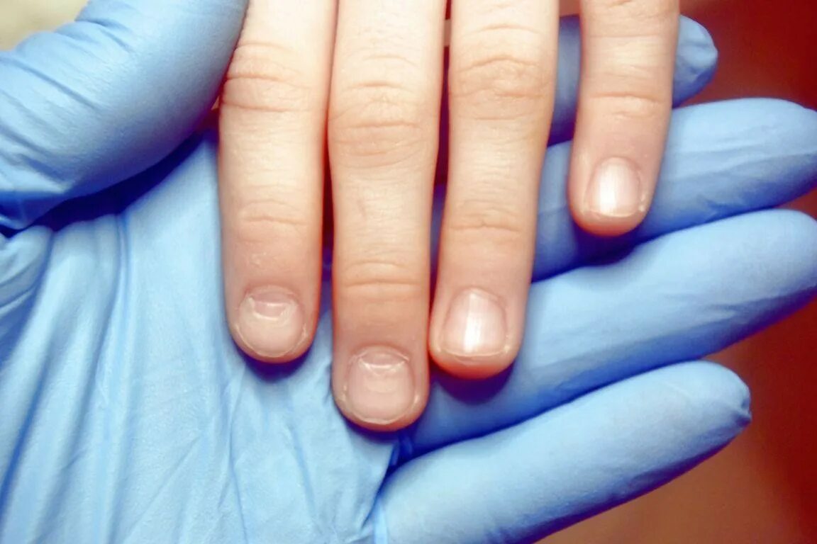 Ониходистрофия - онихолизис.. Ногти для детей. Почему посинели ногти