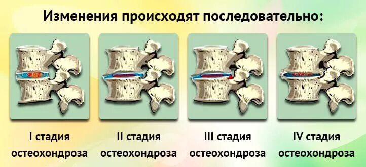 Остеохондроз поясничного отдела позвоночника периоды. Межпозвонковый остеохондроз грудного отдела 1 период. Остеохондроз позвоночного отдела 2 степени. Остеохондроз 1-2 степени грудного отдела. Остеохондроз 2 стадии грудного отдела.