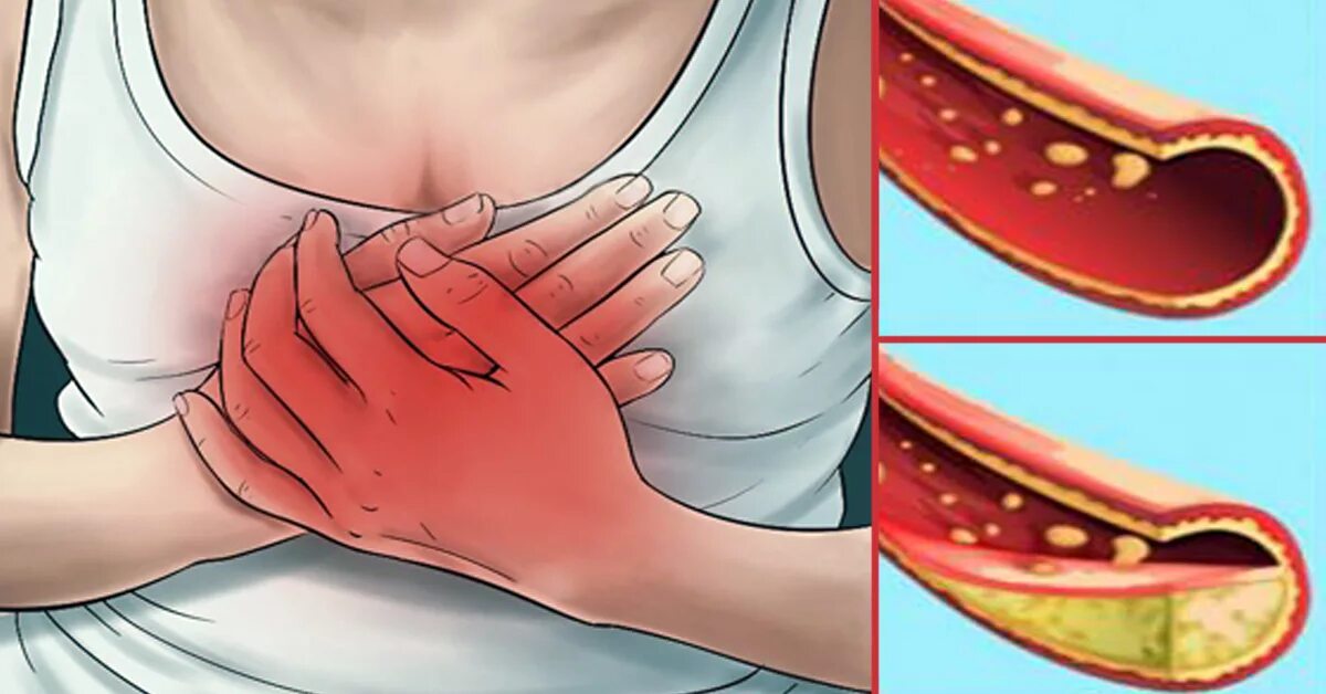 Чем чистить холестериновые бляшки. Жировые бляшки в сосудах. Жировые отложения в сосудах.