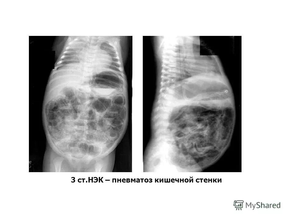 некротический энтероколит у недоношенных. энтероколит новорожденных мкб 10. нэк у новорожденных рентген. некротический энтероколит рентгенограмма. нэк клинические рекомендации новорожденных.