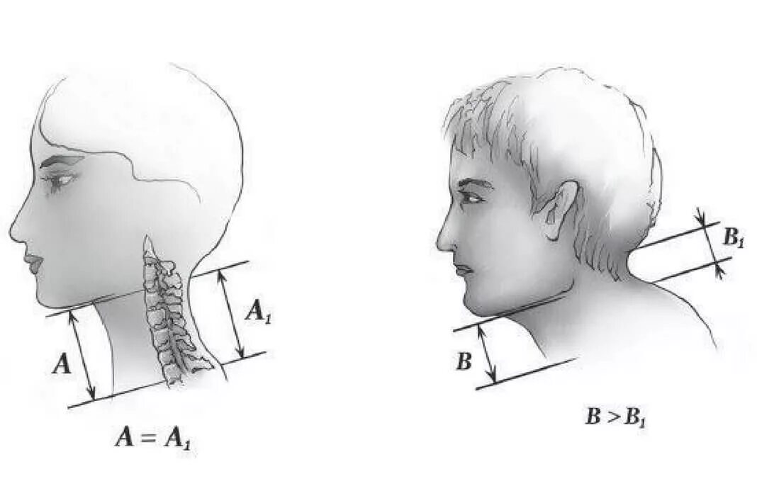 Положение затылка. Шейный гиперлордоз холка. Холка человек рисунок.